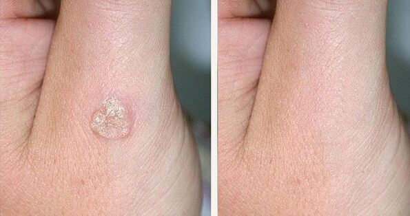 Fotod enne ja pärast soolatüügaste eemaldamist looduslike vahenditega